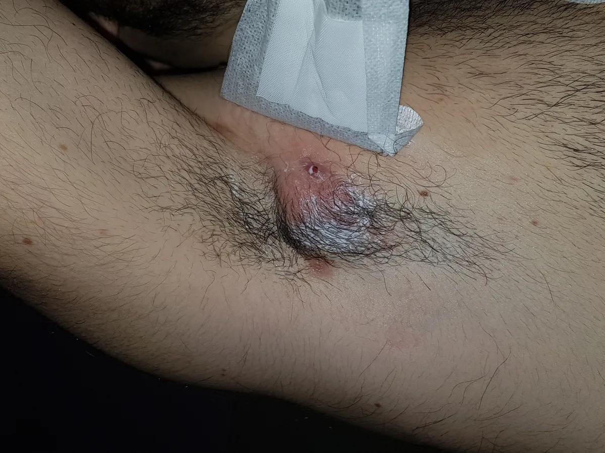 Ascella con grande nodulo infiammato da Idrosadenite Suppurativa all'esordio