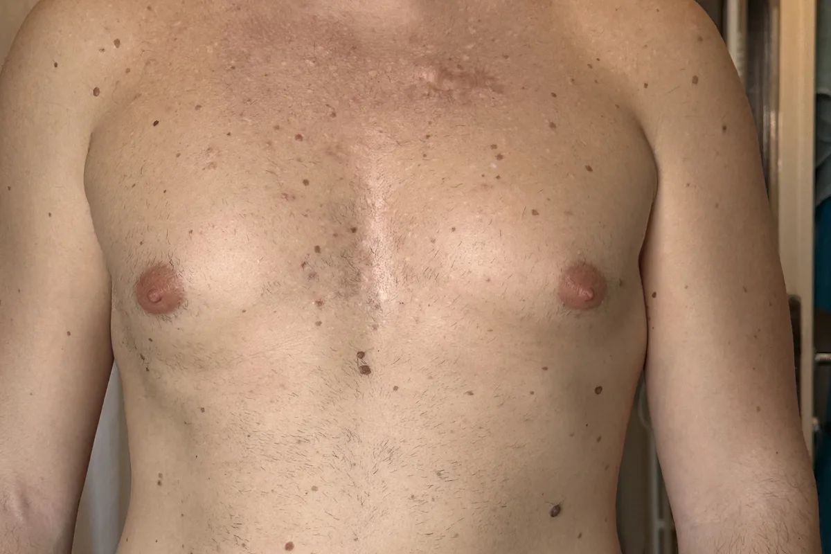 Lo stesso petto sette anni dopo: pelle stabile con cicatrici residue