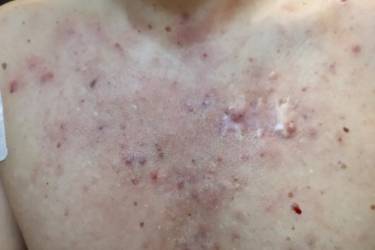Petto con lesioni attive e cicatrici da Idrosadenite Suppurativa